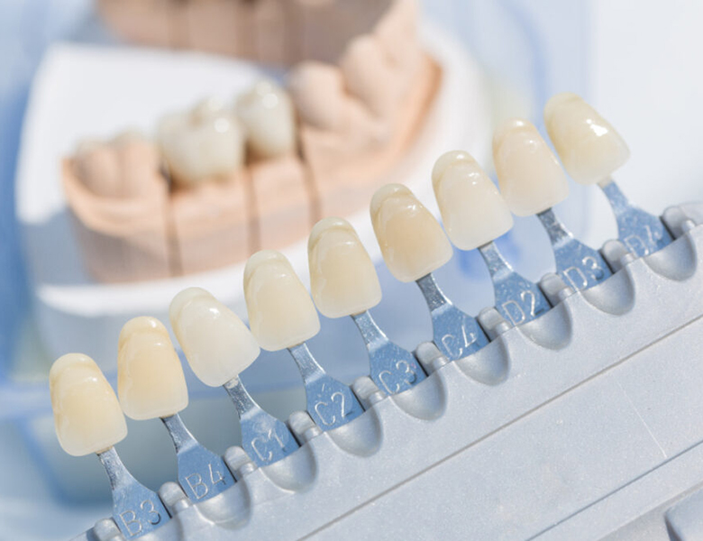 仙台市青葉区台原の歯医者、台原みなも歯科クリニックの審美歯科