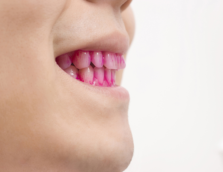 仙台市青葉区台原の歯医者、台原みなも歯科クリニックの歯周病治療