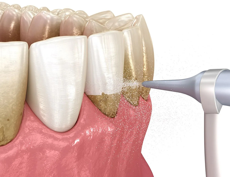 仙台市青葉区台原の歯医者、台原みなも歯科クリニックはGBTシステム導入