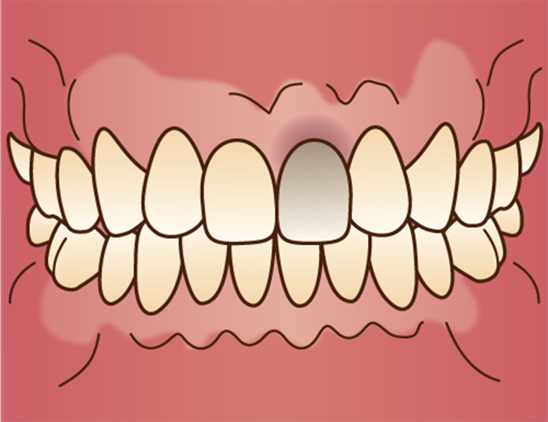 仙台市青葉区台原の歯医者、台原みなも歯科クリニックのホワイトニング
