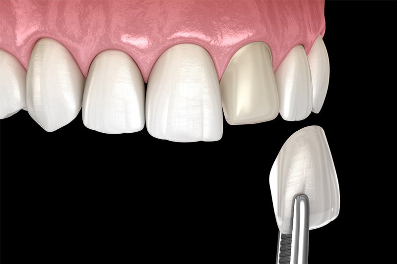 仙台市青葉区台原の歯医者、台原みなも歯科クリニックの審美歯科治療